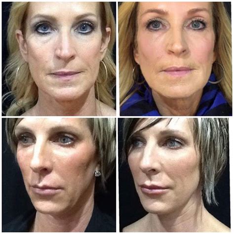 sculptra duluth smile line fillers northern minnesota twin ports dermatology duluth mn