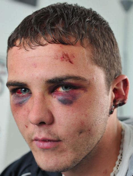 Young Man 20 Has Ear Lobe Bitten Off And Suffers Fractured Eye Socket