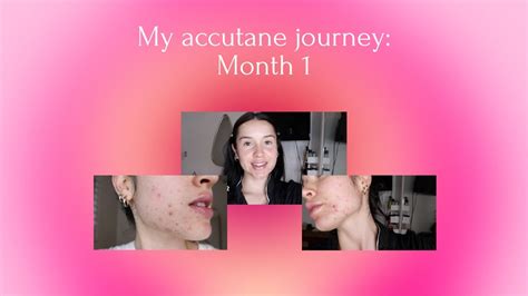 My Accutane Journey Round Month YouTube