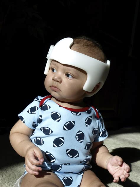 Babys Head Shape Flat Spots Torticollis And Helmets Oh My Baby