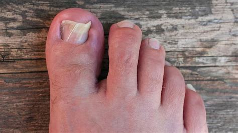 Causes And Tips To Treat And Prevent Ingrown Toenails Onlymyhealth