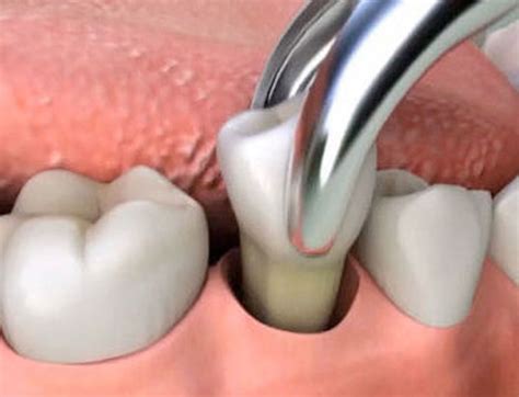 Dentist On Main Dentist Cape Town Tooth Extraction