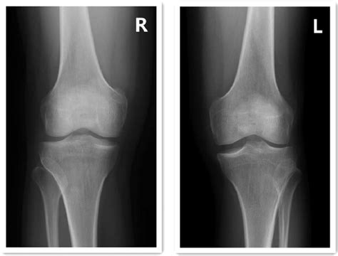 Standing Anteroposterior Radiographs Of Both Knees Radiography Showed