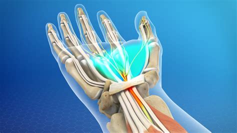 Carpal tunnel syndrome comes on gradually. Carpal Tunnel Syndrome | Total Body Chiropractic