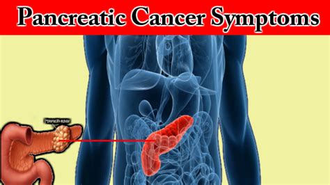 Recognize Few Extreme Pancreatic Cancer Symptoms