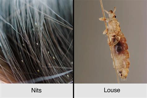 A Guide To Head Lice Symptoms Treatments Prevention The Healthy