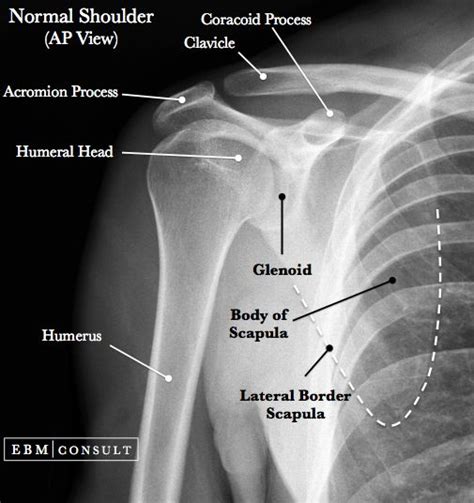 Anterior Shoulder Dislocation General Review Radiology Student