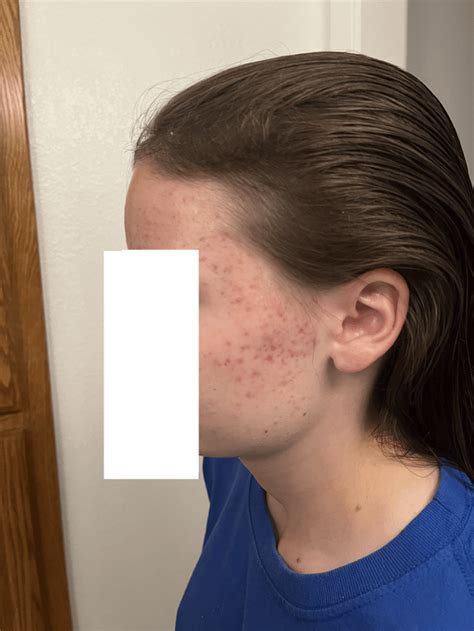 Acne Routine Help Dealing With Red Marks After Acne R