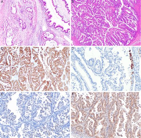 Mucinous Carcinoma Of The Ovary Mc Infiltrative Type Of Invasion