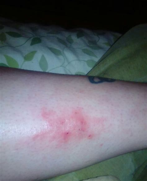 I Have Rash On My Leg Its Only Got Worse It Itches And Feels Hot