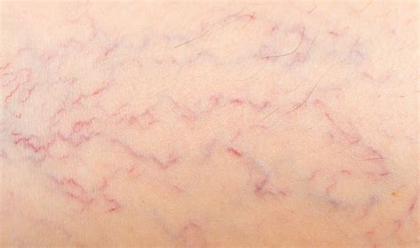What Causes Varicose Veins In The Arms And Hands