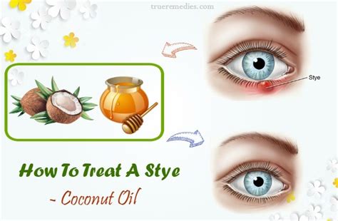 26 Ways How To Treat A Stye On Eyelid And Inside Eye Fast At Home