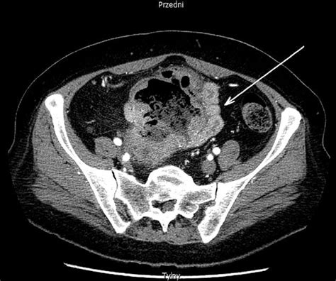 Ct Abdomen Following Contrast Media Administration A Tumor Of The