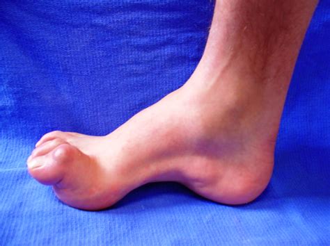 Charcot Marie Tooth Disease 7 Effective Symptoms And Causes