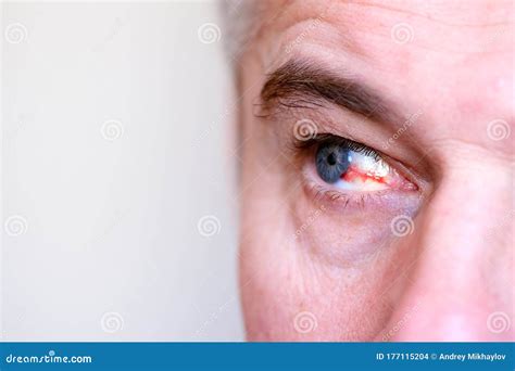 Ophthalmology Burst Capillary Of The Eye The First Sign Of A