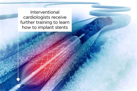 What You Should Know Before Getting A Heart Stent The Healthy