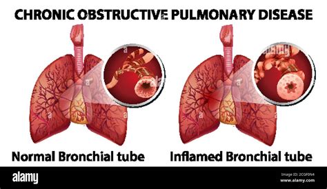 Ilustraci N De La Enfermedad Pulmonar Obstructiva Cr Nica Imagen Vector