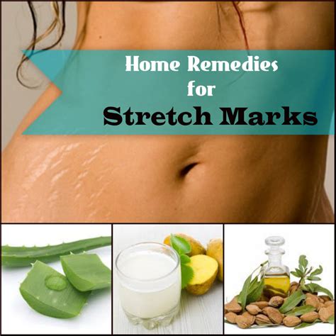 Home Remedies For Stretch Marks Now No Ugly Notch