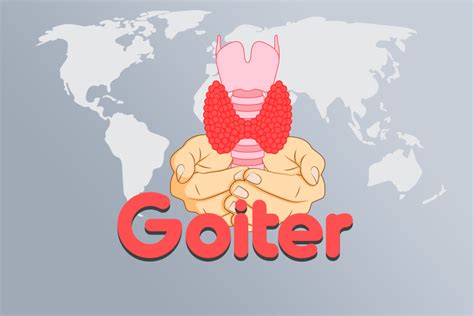 Understanding Goiter Symptoms Causes And Diagnosis Codes