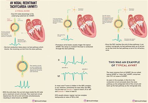 Visual Guide To AV Nodal Reentrant Tachycardia AVNRT GrepMed
