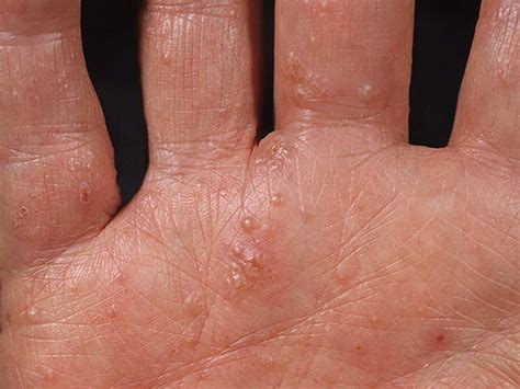 Dyshidrosis Of Hands And Feet Causes Symptoms Treatment Ointments