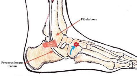 Cuboid Syndrome Ankle Foot And Orthotic Centre