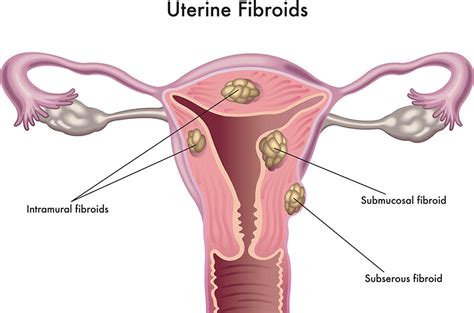 What Are Fibroids A Fibroid Is A Non Cancerous Tumour That Grows In And Around The Womb Uterus