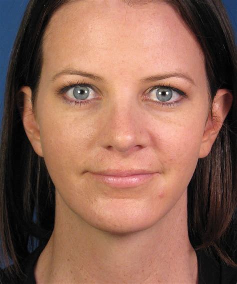 Chin Implant Augmentation Of Jaw Facial Enhancement San Diego Ca