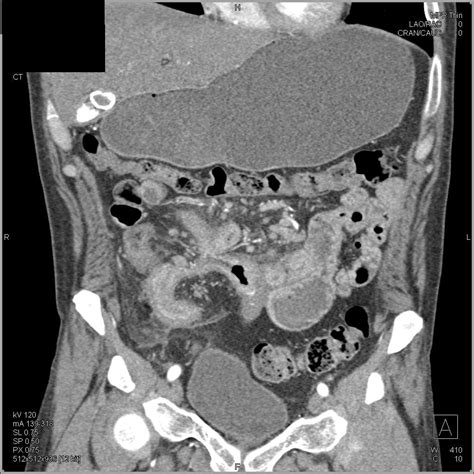 Small Bowel Enteritis With Thickened Bowel And Mesentery Small Bowel