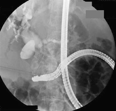 Conventional Side Viewing Duodenoscope For Ercp In Patients Who Had
