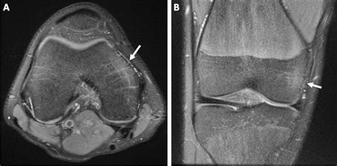 Magnetic Resonance Imaging Of The Right Knee At 15 Years Of Age Axial