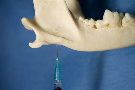 Nerve Blocks For Oral Surgery In Dogs Clinicians Brief