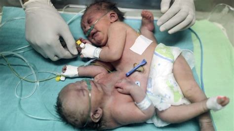 Gaza Conjoined Twins Survive Separation Surgery Bbc News
