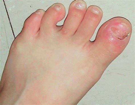 Stubbed Toe Symptoms Causes Treatment