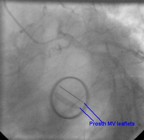 Prosthetic Heart Valves On Cxr All About Cardiovascular System And