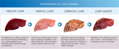 Liver Disease Rash Pictures Photos
