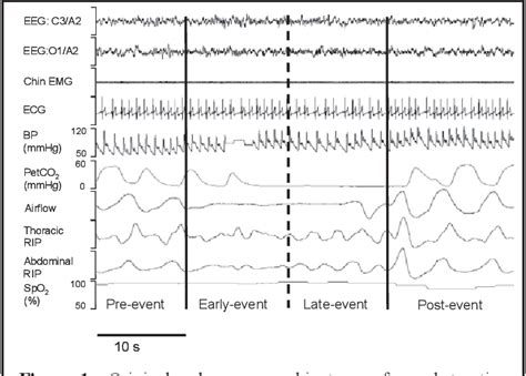 Figure 1 From Acute Cardiovascular Changes With Obstructive Events In