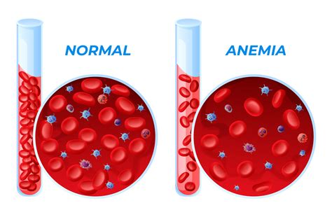 Anaemia During Pregnancy Types Causes And Treatments Healthengine Blog