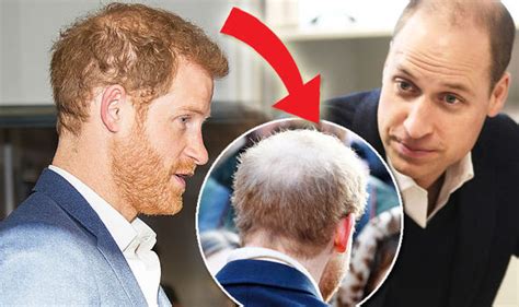 Why Are Prince Harry And William Going Bald What Can You Do To Prevent