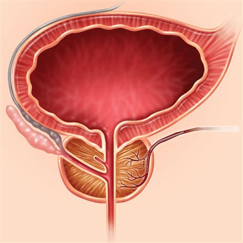 What You Should Know About Prostate Artery Embolization PAE Memphis Vascular Center