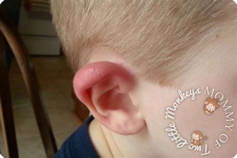Red Swollen Ear Lobe What Happened To His Ear