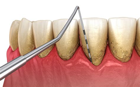 Scaling And Root Planing Miami Fl Periodontist