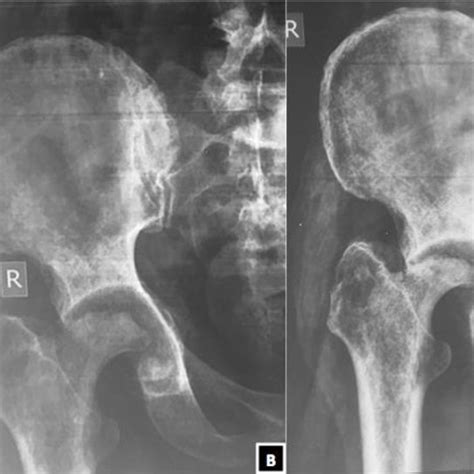Serial X Rays Of The Right Hip Of The Patient In Anteroposterior View