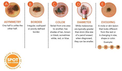 Skin Cancer Early Detection