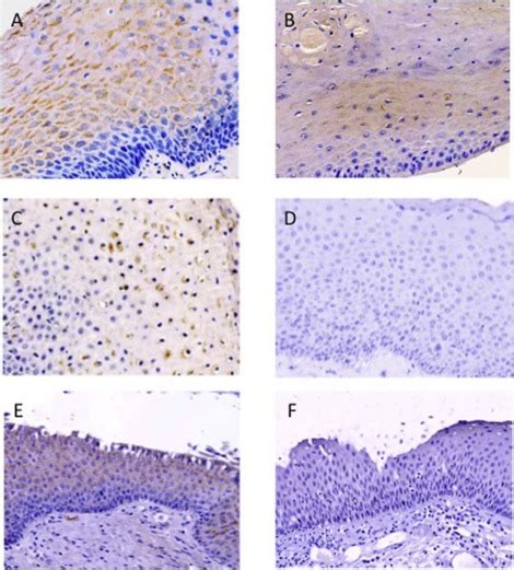 Detecting Laryngopharyngeal Reflux By Immunohistochemistry Of Pepsin In