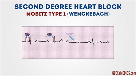 How To Read An Ecg Ecg Interpretation Geeky Medics