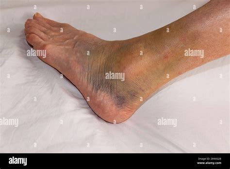 Sprained Ankle Hi Res Stock Photography And Images Alamy