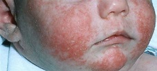 常見的嬰兒濕疹4大類型 – Grahams Natural HK