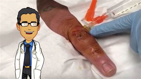Finger Pus Drainage And Medical Minute Double Feature Youtube