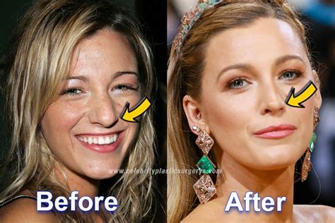 Blake Lively Plastic Surgery Before And After With Pics